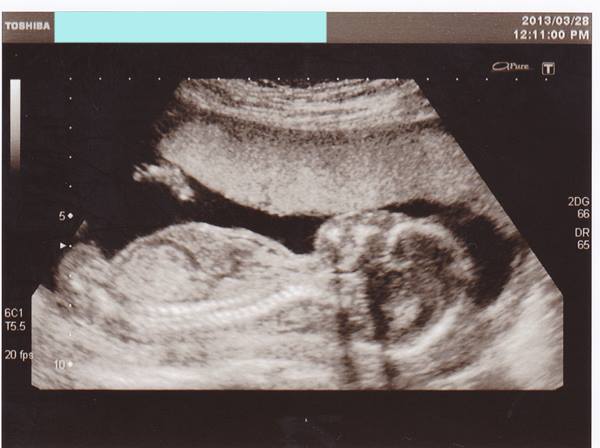 妊娠 初期 エコー 写真 見方